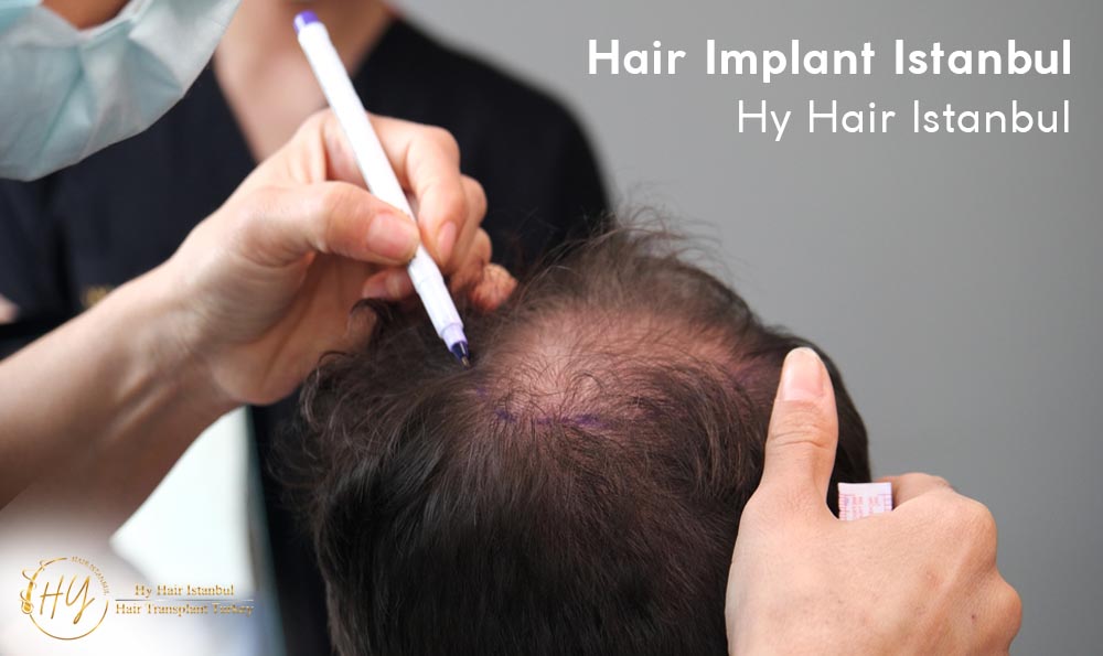 Hair Implant Istanbul- Hy Hair Istanbul - Hyhairistanbul com
