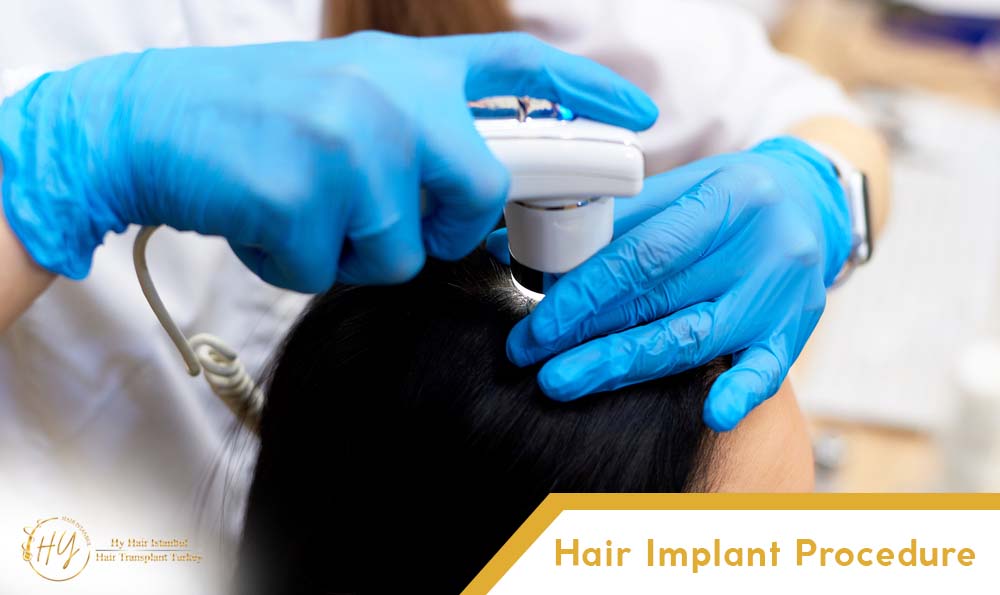 Hair Implant Procedure - Hyhairistanbul com