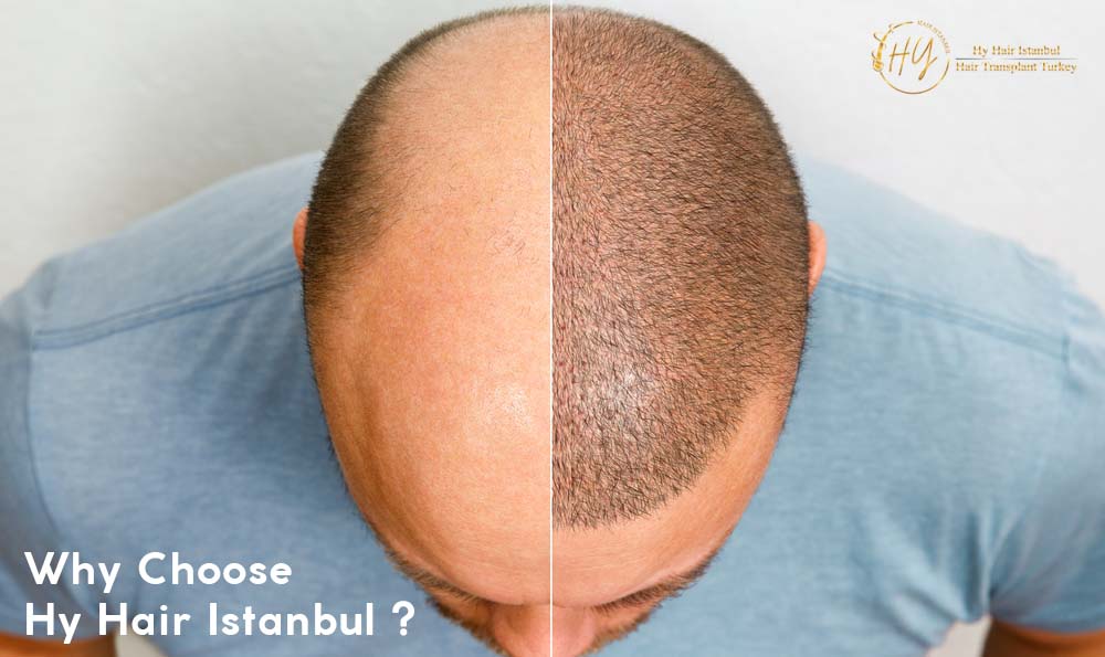Why Choose Hy Hair Istanbul - Hyhairistanbul com
